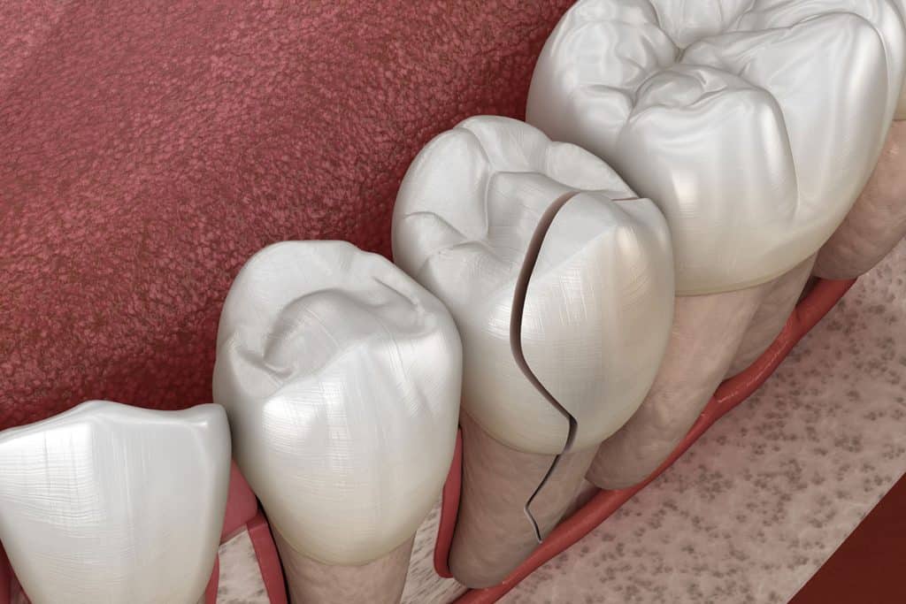 Can A Cracked Tooth Heal On Its Own?