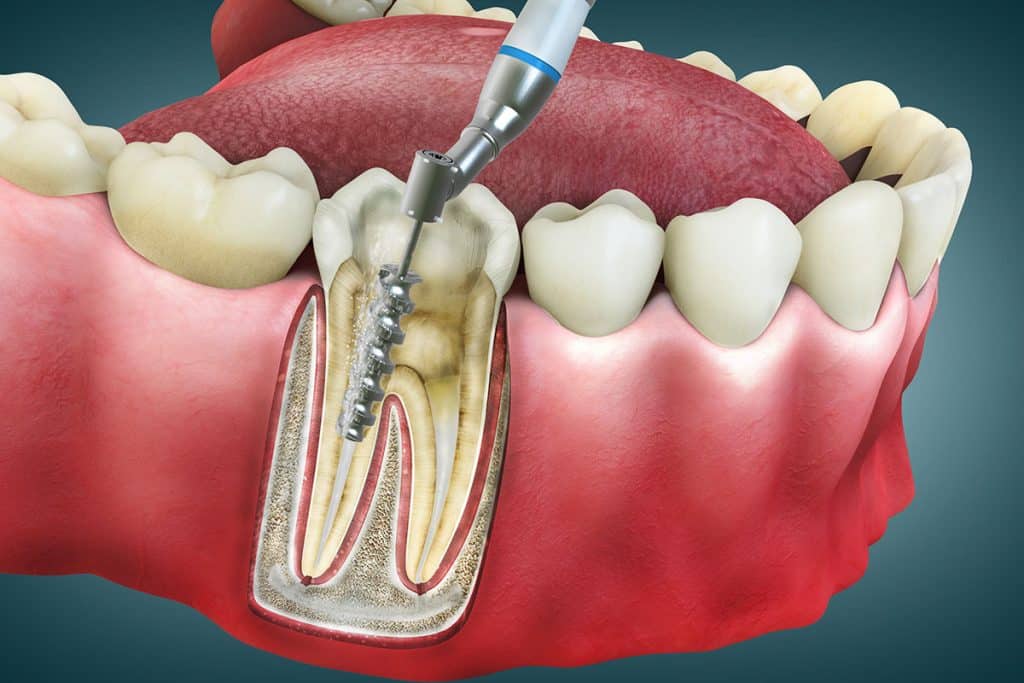 What Is A Root Canal?